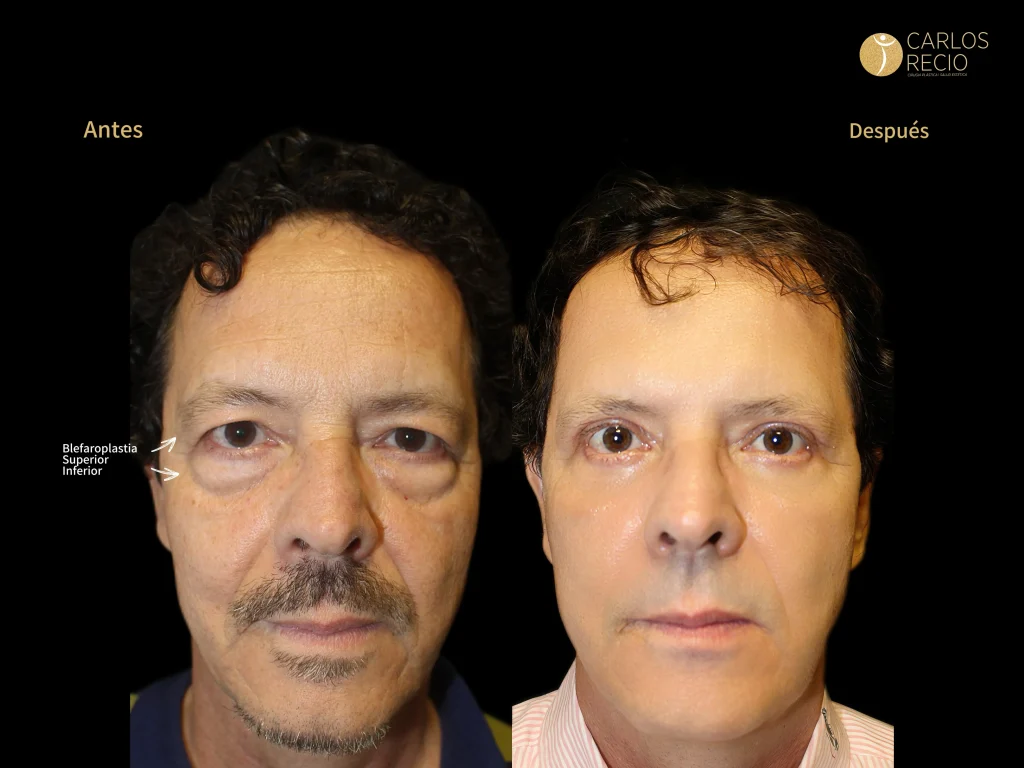 Blefaroplastia: el secreto para rejuvenecer tu mirada Blefaroplastia: el secreto para rejuvenecer tu mirada